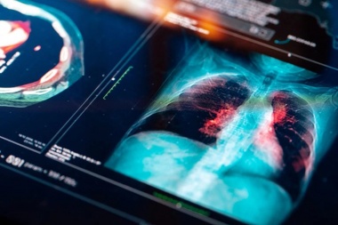 El 70% de los cáncer de pulmón se detectan en etapa avanzada: cuáles son los síntomas y cuándo consultar